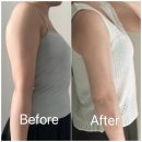 멍빨래 | 팔뚝람스 멍 붓기 빨리 빼는 방법 팔람스 2주차 후기