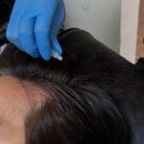 동인약국 | 남편 수원탈모치료 SMP STUDIO본점 줄기세포 엑소좀 시술 탈모관리 세번째 방문 후기