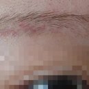 [일원1] 나의 피부를 설계하다 (6주: 3/4~4/8) | 눈썹문신제거 시술 후기 / 일주일치 자세한 사진 기록