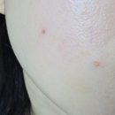 제로뷰티 - 의정부시 | ​의정부 기미잡티제거 내돈내산 미작뷰티 제로스팟 1회 솔직후기