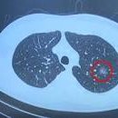 부부의학박사 홍혜걸기자의 폐암 이미지