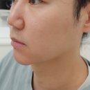 페이스 | 남자 피부관리로 받은 튠페이스 효과 가격 후기