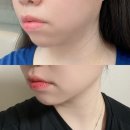 동네방네의료기 | 동성로피부과에서 볼뉴머300샷+슈링크300샷 볼링크3주 경과 후기