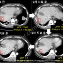 GPC카페 | [간암] 신약임상연구로 도전 1편 – GPC-3 표적치료 편