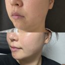 닥터봄춘의원 | 대전올타이트리프팅 최초도입피부과+키닥터원장시술 내돈내산 후기