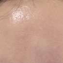 미라셀(주) | 미라셀 줄기세포 피부주사 시술당일 후기