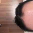 5994 | 성수동피부관리 트리버에스테틱에서 스킨널싱 여드름케어 솔직후기