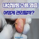 강동천호정형외과의원 | 강동구 천호정형외과 l 내성발톱 고름 염증, 어떻게 완화할 수 있을까?