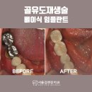 뼈이식 임플란트 후기GBR(골유도재생술) 광명 서울대치과 임플란트 전문병원