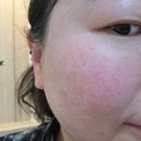 화명역 롯데마트 앞 | 부산 리투오 받고 정착한 양산 피부과 내돈내산 후기