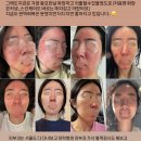 다보약국 | 주사피부염, 지루성피부염 돈 수백 써도 무소용. 극복중인 피부회복 현재 진행형 이야기