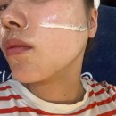 강남 선릉피부관리 부작용없는 에그 스킨플래닝 뷰티인시아 에스테틱 후기