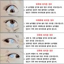 전주 하드렌즈, 초 고도 근시와 난시로 난시용 칼라렌즈를 착용하면 물체가 흐리고 눈 피로가 심했는데...
