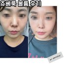 동탄 피부과 쥬베룩 볼륨후기 일주일차 비포애프터