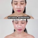 아로美피부관리실 | 예신 필수추천 아로뮤에스테틱 뮤프팅, 둔산동 윤곽관리 후기