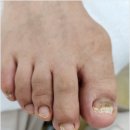 레푸스 호매실점 | 수원 권선동 호매실 발톱무좀 내돈내산 만족 후기 레푸스 호매실점