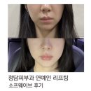 청담동피부과 소프웨이브 후기 | 탄력·잔주름 개선 리프팅 효과는?