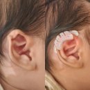 신생아 귀교정기 사용 후기! 메딧트 소프트핏 클립으로 접힌 귀 교정 중(내돈내산)