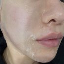 빨리팔아 | 팔자주름름 개선 기대하고, 손품팔아 찾은 테이아의원 티타늄 시술 솔직 후기