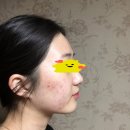대구 여드름치료 한의원 ] 3개월 정안치료 후기에요!