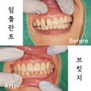 진접역치과에서 사고로 인한 앞니 임플란트도 단기간에 가능해요