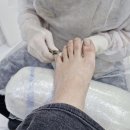 레푸스 구월점 내성발톱 무좀발톱 발각질 문제성발 이미지