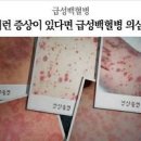 백혈병 초기증상 원인 골수이식 급성 소아 백혈병 증상 생존율 이미지