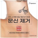 비앤씨피부과의원 | 문신제거 후 관리 물집, 딱지 이 방법으로 진행하세요