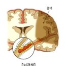 사망률 1위 뇌혈관 질환의 危嚴~! 이미지