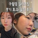 정관에스(S)한의원 | 인천 실리프팅 후기 구월동 실리프팅 2주 경과 심부볼 팔자 변화 솔직 정리