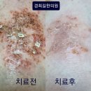 [피부염] 가려움과 진물...한달 열흘만에 80%호전, 피부질환 병원추천(치료전후 사진) 이미지