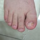내성지구대 | 울산 무좀 발톱 레푸스 삼산점 관리 후기