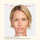 미소지움피부과의원 | 레디어스 후기? 4주 후, 6개월 후 변화 모습