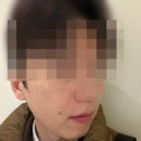 모델로피부과의원 | 강남역 피부과 30대 남자 쥬베룩볼륨 후기 [베러미의원 강남]