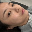 리즈멍 | 대구 동성로 리즈네 스킨부스터 통증 다운타임 멍 효과