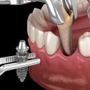 동그라미 치과기공소 | 앞니 임플란트 발치 즉시 식립 (성북구 임플란트)