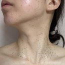 이삭한의원 | 편평사마귀 제거 후기 | 3대 편평사마귀 성지 인천 이삭가정의학과 Co2, 어븀야그 레이저 가격 + 예약...