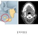 타석증 , 원인, 침샘 타석증 예방 방법 이미지