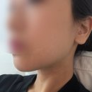 더400 | 부산 올타이트400샷 내돈내산 후기 부산리프팅 잘하는곳