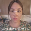 청요리식당 | 수술 기증늑 실리콘 콧대 코끝 긴 코 화살코 비순각교정 수술 리얼 후기 - 4일차~일주 일차(정보 공유 O)