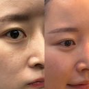 300 | 강남 써마지 300샷 후기 효과 가격 내돈내산 출산선물 모공 탄력리프팅