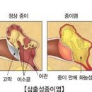 삼출성 중이염 증세 원인 성인 중이염 낫는법 이미지