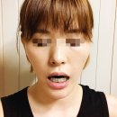 40대 주걱턱 치아교정 3년 차의 조언