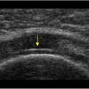 회전근개파열 - 극상근 (Rotator Cuff Tear - Supraspinatus) 이미지