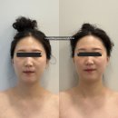 마노아뷰티 - 서구 | 청주신부관리 후기｜드레스 핏 살리는 승모근·어깨라인 관리 마노아뷰티