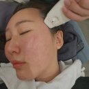 광주 남구 주월동 피부과 지석진 리프팅 써니 고주파 2주차 후기