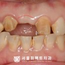 퍼펙트치과기공소 네이버블로그