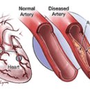 심장에 혈액 공급하는 혈관 - 관상동맥 이미지