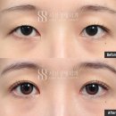 [시선성형외과 반달눈성형] 쌍꺼풀보다 중요한 건 눈모양입니다(6개월차 경과)