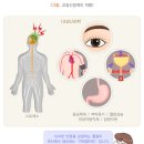 갈색세포종 이미지